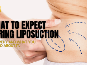 What To Expect After Recovering From Liposuction And What You Can Do!
